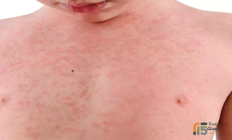 أعراض الحصبة