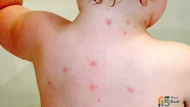 اعراض مرض الجدري