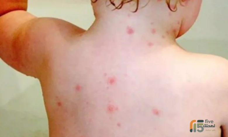 اعراض مرض الجدري