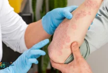 علاج الإكزيما