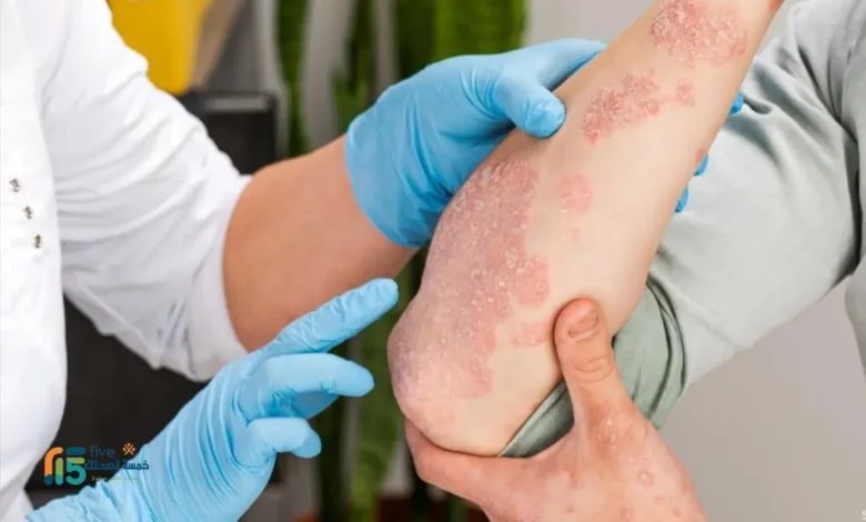 علاج الإكزيما